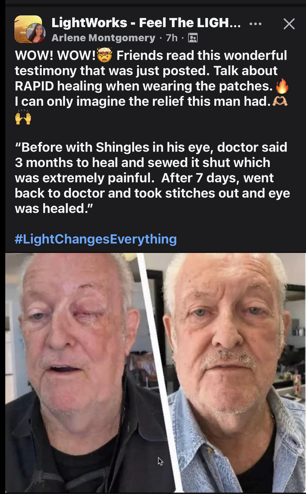 Shingles Healed with LifeWave Patches
