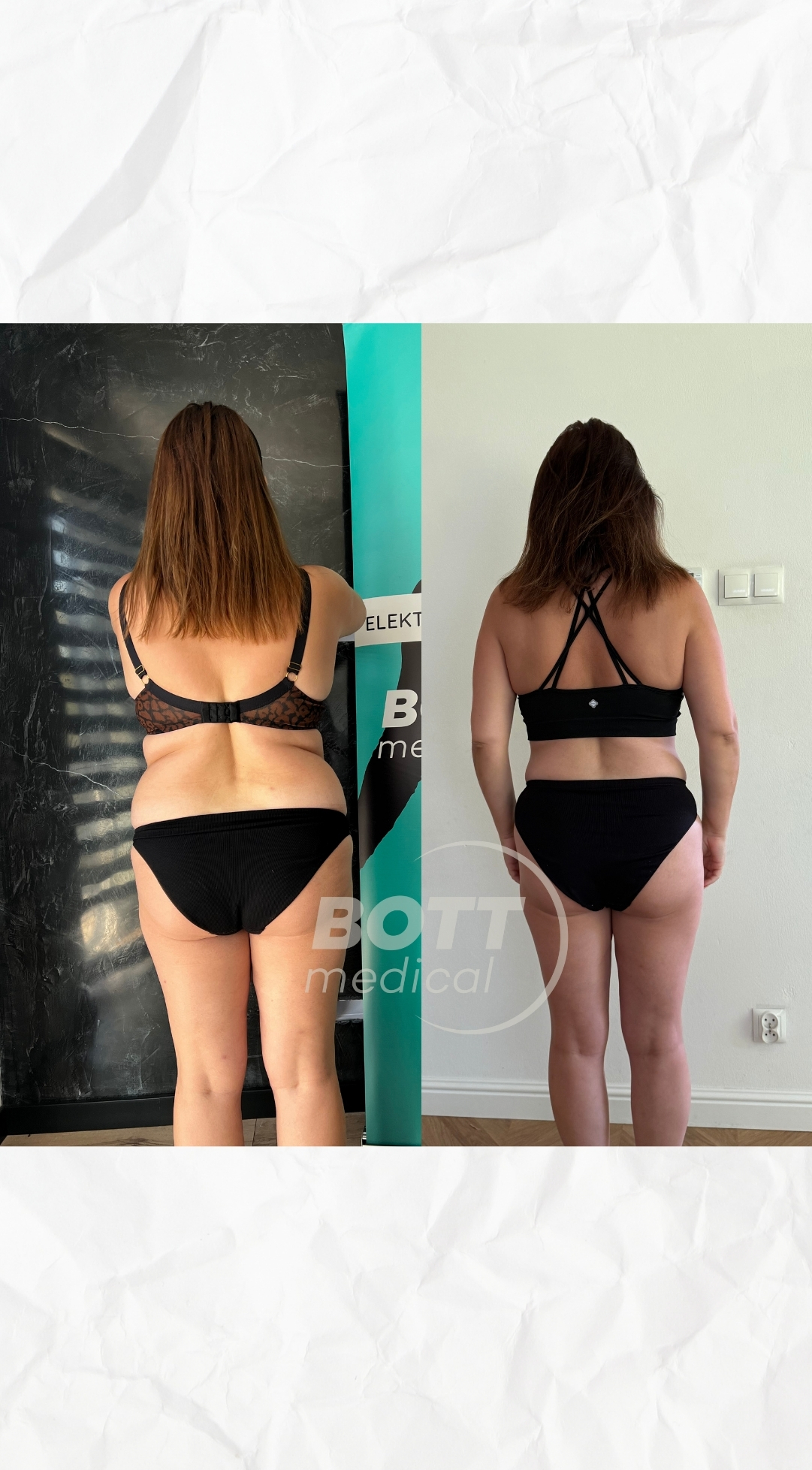 Efekty Przed Cellulit