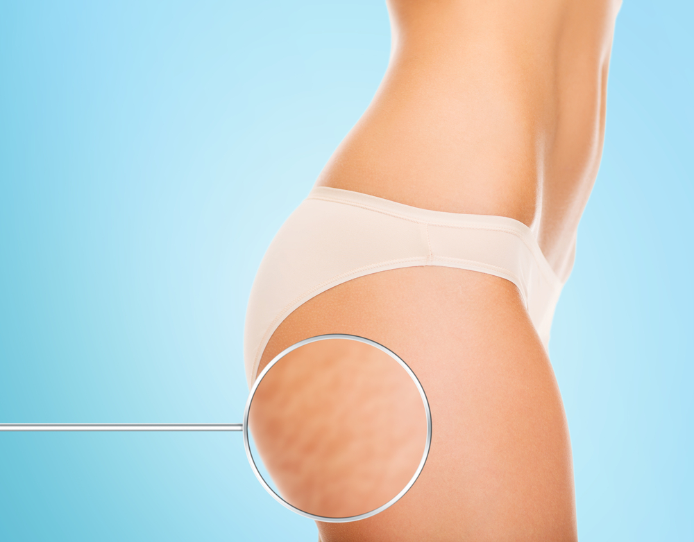 cellulite e ritenzione idrica nei glutei