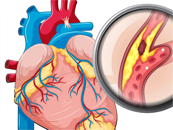 COVID-19 và bệnh lý tim mạch
